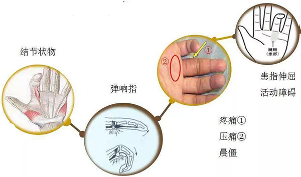 手腕腱鞘炎位置图片